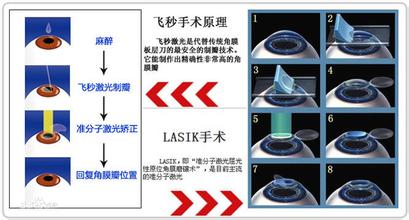 激光在治疗近视方面的应用